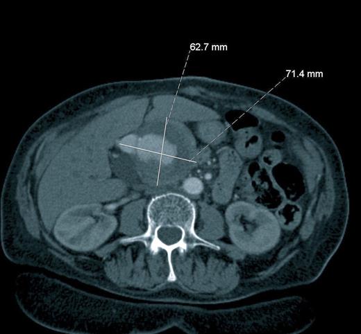 Axial Computerised Tomography scan after administration of intravenous contrast showing a giant hepatic artery aneurysm