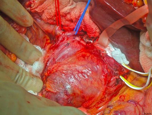 Intraoperative image showing the aneurysm arising from the common hepatic artery (white sling) and its relationship to the left and right hepatic arteries (red and blue slings)
