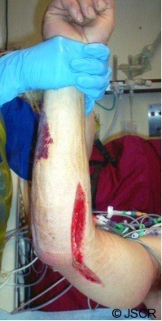 Volar incision