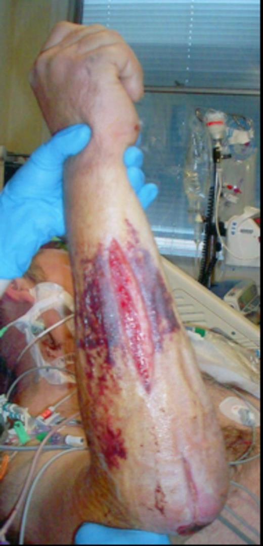 Dorsal and olecranon incisions