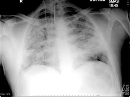 Acute Respiratory Distress Syndrome