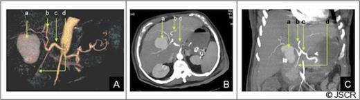 CT of the abdomen: A) Tridimensional reconstruction, B) Axial slice C) Coronal slice (a;.Pseudoaneurysm of the right anterior hepatic artery, b;Left hepatic artery, c;Common hepatic artery, d;Gastroduodenal artery). The right posterior hepatic artery arises from the left hepatic artery.