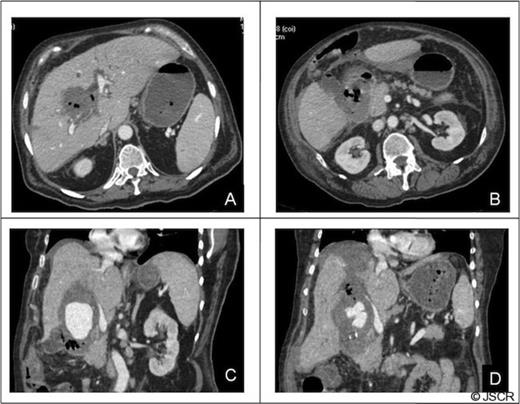 CT of the abdomen: Complications of the pseudoaneurysm A, B) Hepatic infarction C)Duodenal wall involvement, D) Hemoperitoneum under right hemidiaphragm.