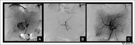 Liver arteriography: A) Selective arteriography of the common hepatic artery showing a pseudoaneurysm of the right anterior hepatic artery, B and C) Result after embolization with coils and an Amplatzer vascular plug. The figure shows a complete occlusion of the pseudoaneurysm and the right anterior hepatic artery.