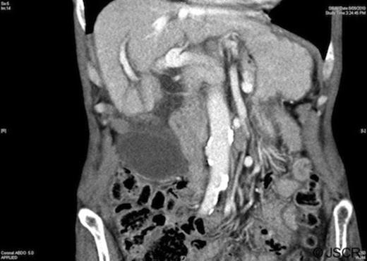 Computed tomography demonstrating a low-lying gallbladder with a diffusely thickened wall and pericholecystic fluid