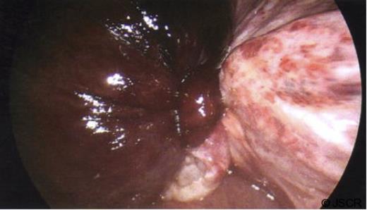 Laparoscopic view of the gangrenous gallbladder, with a 360 degrees clockwise torsion on its mesentery