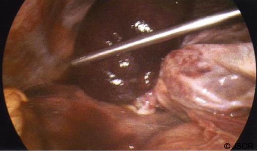 Laparoscopic view of the gangrenous gallbladder, with a 360 degrees clockwise torsion on its mesentery