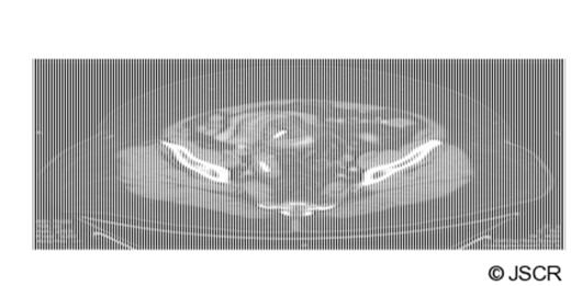 Cross sectional and coronal images of biliary stent in the sigmoid colon lumen with perforation through the bowel wall and surrounding abscess cavity