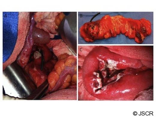 (A) Perforation of plastic biliary stent through sigmoid colon wall in vivo. (B) Perforation of plastic biliary stent through sigmoid colon wall ex vivo. (C) Abscess cavity shown to be contained within a loop of small bowel.