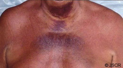 The patient’s anterior chest wall and neck upon initial presentation. Provided by the clinical photography department; Royal Sussex County Hospital; under full patient permission.