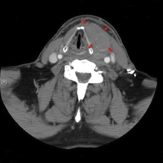 Axial CT image demonstrating the left anterior cervical mass (outlined with arrows) and associated contralateral shift of the adjacent airway.