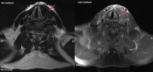 MRI imaging (pre then post contrast) demonstrates enhancement of the left sided mass with gadolinium (arrow); suggesting the presence of blood. The carotid sheath (*) can be seen separately from the mass and is marginally displaced posteriorly.