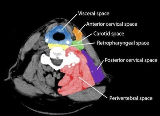 Digital colouring of potential neck spaces (normal left neck) with respective fascial boundaries.