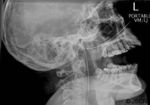 Plain radiograph of the head and neck was performed, showing an alpha-loop having formed in the naso-pharynx
