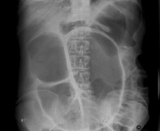 Abdominal X-ray showing colonic dilatation