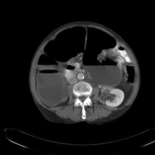 CT abdomen showing dilatation of ascending and transverse colon upto splenic flexure with air fluid levels.