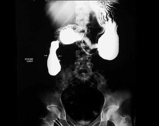 Upper gastrointestinal series. Intraluminal duodenal diverticulum, pear-shaped sac, occluding duodenal lumen (arrows).