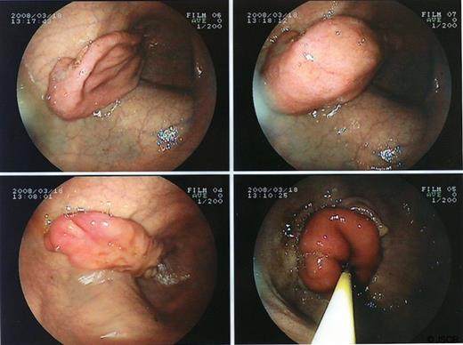 Upper intestinal endoscopy showing the inverted intraduodenal diverticulum