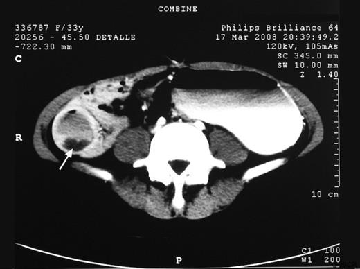 CT appearance of the intraluminal duodenal diverticulum (arrow).