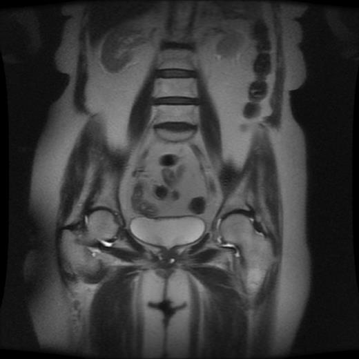 MRI of the Pelvis Showing Two Separate Urethral Diverticula
