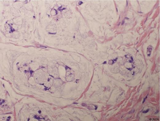 H&E Stain of the Signet Ring Adenocarcinoma from the Urethral Diverticulum