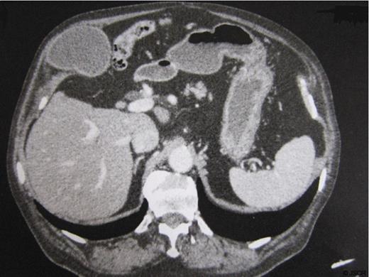 Lithiasic gallbladder herniated through the abdominal wall