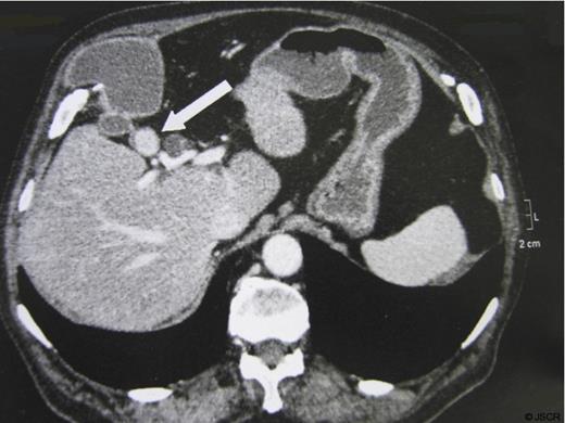 Obstructive infundibular stone