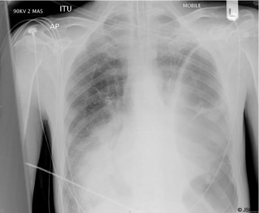 Chest radiograph shortly after admission