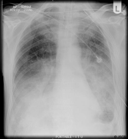 Postoperative radiograph following placement of chest drain