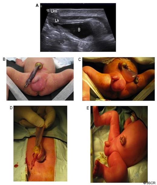 Patent urachus with allantoic cyst presenting as an umbilical cord cyst. A, Postnatal appearances of patent urachus on ultrasound (Ur, urachus; B, bladder; Um, umbilicus). B, Umbilical cord cyst collapsed; C, Allantoic cyst filled following cystoscopy (at cystoscopy a normal bladder outlet and urethra were found); D, Allantoic cyst and patent urachus in continuity; E, post-op appearance with infra-umbilical incision.