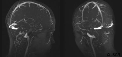 MRV brain images demonstrate bilateral sagittal, straight, transverse and sigmoid sinuses with no evidence of thrombus extension. Both right and left IJV as well as right EJV are clearly patent. The left EJV could not be demonstrated.