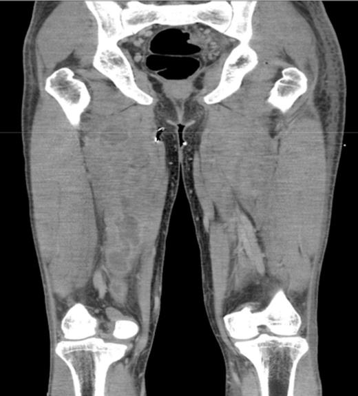CT scan showing multiple abscesses