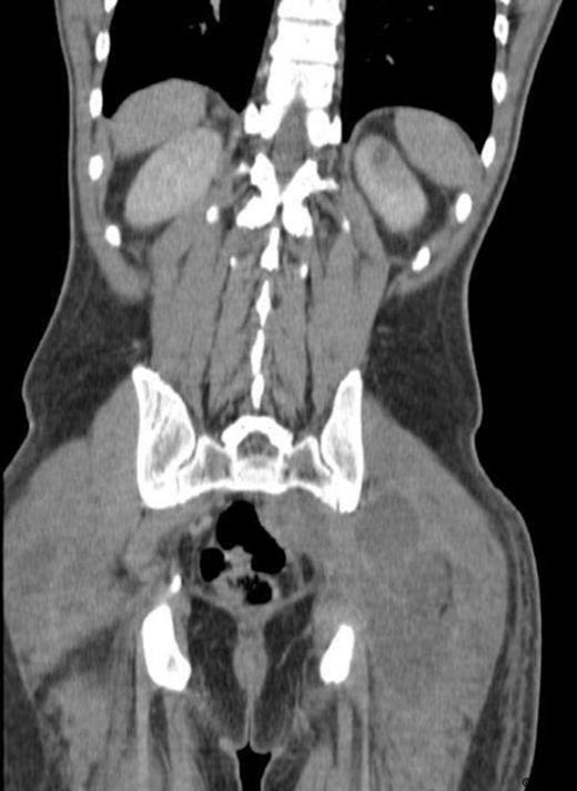 CT scan showing multiple abscesses