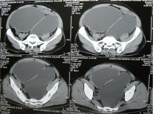 Plain CT scan of abdomen and pelvis showing large bladder diverticulum posterior to the bladder
