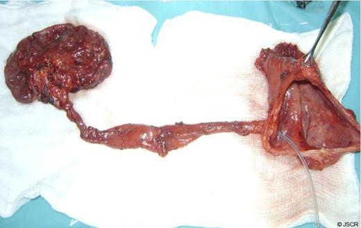 Left nephroureterectomy and bladder diverticulectomy specimen with Left ureter opening into the diverticulum
