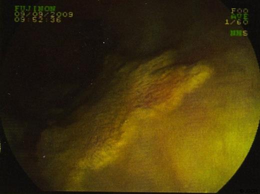 Endoscopic View of Lesion