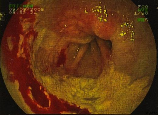 Endoscopic View of Lesion
