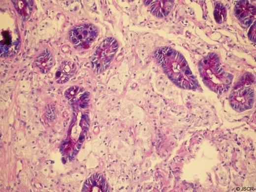 Histology of Lesion