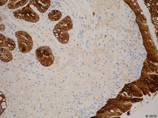 Histology of Lesion