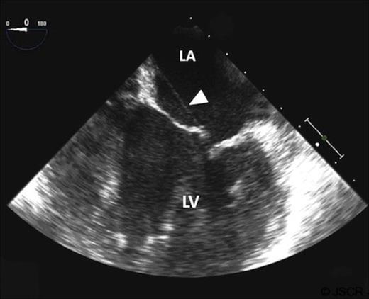 Transoesopahgeal echocardiogram showing aberrant chord in the left atrium, extending from the anterior mitral valve leaflet to the left atrial septum (white arrow).