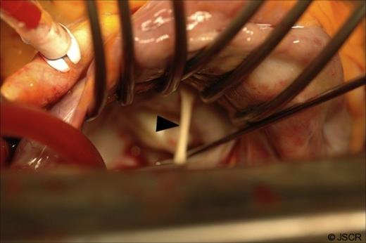 Intra operative picture after the mitral valve is exposed through the inter atrial groove, showing an aberrant chord attached to the A2 segment of the anterior mitral valve leaflet and the atrial septum (Black arrow).