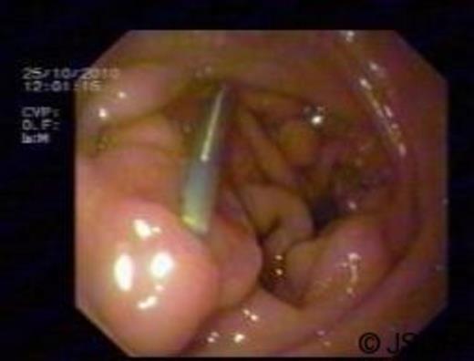 Upper gastrointestinal endoscopy after clip placement for hemostasis.