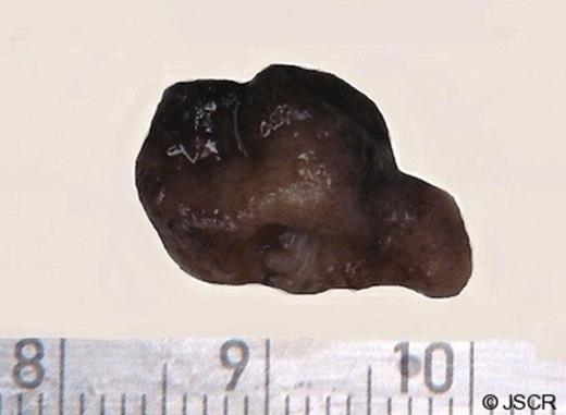 Photograph of the resected specimen shows a 1.7-cm polypoid lesion. The external surface of the polyp is Brown and lobulated with hemorrhagic areas.