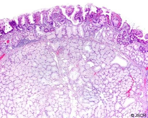 Photomicrograph of Brunner's gland hyperplasia shows lobular proliferation of Brunner's glands, some of which are cystically dilated. The overlying mucosa exhibits duodenitis (original magnification, ×40; hematoxylin-eosin stain).