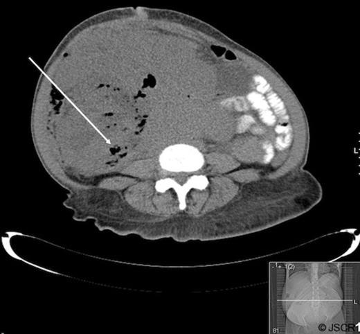 Abdominal and pelvic CT of patient A demonstrating a large mass with air pockets (arrow).