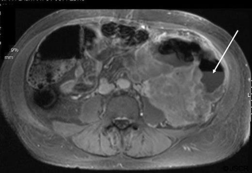 Abdominal MRI of patient B demonstrating an air-fluid level (arrow) of the descending colon with surrounding mass.