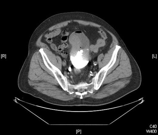 CT scan showing the large heterogenous mass filling the bladder lumer