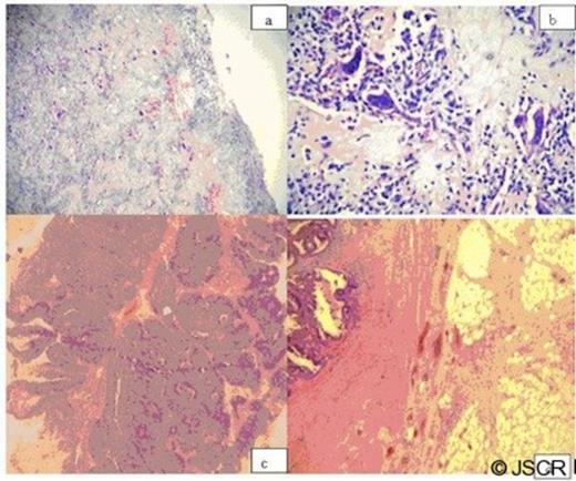 (a) The osteosarcomatous infiltration of the bladder wall charecterised by production of ostoid and osteoclastic giant cells (HE, x10). (b) View of a sarcomatous component (HE, x 60). (c) Areas of high-grade invasive urothelial carcinoma in the same case(HE, x10). (d) Sigmoid colon wall; Sarcomatous infiltration of serosal surfaces with imultaneously colonic adenocarcinoma with muscular layer infiltration (HE, x10)