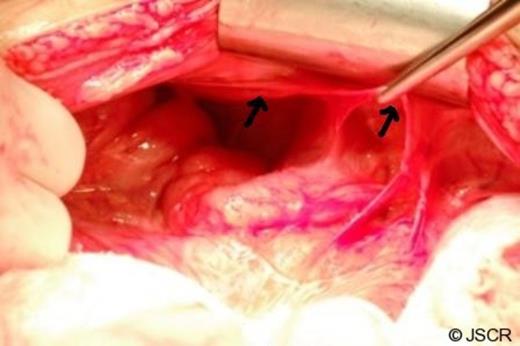 Thin membrane that was encasing the stomach, small intestine and part of the ascending colon (black arrows)