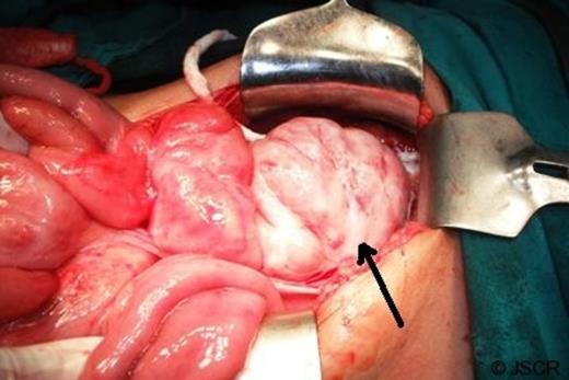 Jumbled up terminal ileum encased within another thick membrane (black arrow)